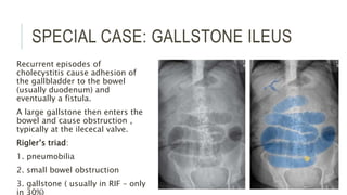 SPECIAL CASE: GALLSTONE ILEUS
Recurrent episodes of
cholecystitis cause adhesion of
the gallbladder to the bowel
(usually duodenum) and
eventually a fistula.
A large gallstone then enters the
bowel and cause obstruction ,
typically at the ilececal valve.
Rigler’s triad:
1. pneumobilia
2. small bowel obstruction
3. gallstone ( usually in RIF – only
in 30%)
 