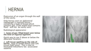 HERNIA
Protrusion of an organ through the wall
of the cavity.
Only hernia seen on abdominal
radiograph is inguinal hernia –
containing a loop of bowel which
contains gas. If the bowel loop contains
fluid – will not be easily seen.
Radiological appearance :
1. loops of gas-filled bowel seen below
the level of inguinal ligament.
Quick way to see if above or below the
obturator foramen.
2. soft tissue swelling on the side of
hernia : loop of bowel (black) and soft
tissue (light grey) . This is due to
herniated mesenteric fat/ associated
oedema
 
