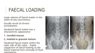 FAECAL LOADING
Large volume of faecal matter in the
colon of any consistency.
Usually result of chronic
constipation.
Hardened faecal matter has a
characterstic appearance:
1. rounded masses
2. mottled or granular texture
Hardened faecal matter within the
right side of the colon – highly
suggestive of faecal loading as the
faecal material here normally of fluid
consistency.
 
