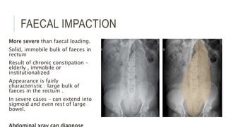 FAECAL IMPACTION
More severe than faecal loading.
Solid, immobile bulk of faeces in
rectum
Result of chronic constipation –
elderly , immobile or
institutionalized
Appearance is fairly
characteristic : large bulk of
faeces in the rectum .
In severe cases – can extend into
sigmoid and even rest of large
bowel.
 