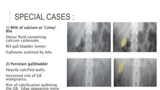 SPECIAL CASES :
1) Milk of calcium or ‘Limey’
Bile
Dense fluid containing
calcium carbonate.
RO gall bladder lumen
Gallstone outlined by bile.
2) Porcelain gallbladder
Heavily calcified walls.
Increased risk of GB
malignancy.
Rim of calcification outlining
the GB. Edge appearing more
 