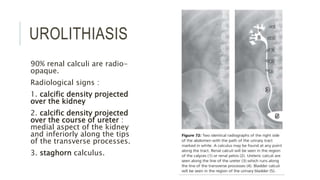 UROLITHIASIS
90% renal calculi are radio-
opaque.
Radiological signs :
1. calcific density projected
over the kidney
2. calcific density projected
over the course of ureter :
medial aspect of the kidney
and inferiorly along the tips
of the transverse processes.
3. staghorn calculus.
 