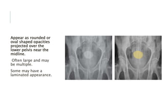 Appear as rounded or
oval shaped opacities
projected over the
lower pelvis near the
midline.
Often large and may
be multiple.
Some may have a
laminated appearance.
 