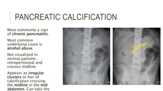 PANCREATIC CALCIFICATION
Most commonly a sign
of chronic pancreatitis.
Most common
underlying cause is
alcohol abuse.
Not visualized in
normal patients ,
retroperitoneal and
crosses midline.
Appears as irregular
clusters or foci of
calcification crossing
the midline in the mid
abdomen. Can take the
 