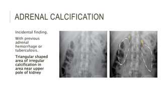 ADRENAL CALCIFICATION
Incidental finding.
With previous
adrenal
hemorrhage or
tuberculosis.
Triangular shaped
area of irregular
calcification in
area near upper
pole of kidney
 