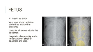 FETUS
11 weeks to birth .
Very rare since radiation
should be avoided in
pregancy
Look for skeleton within the
abdomen.
Large circular opacity and a
linear array of smaller
opacities are seen.
 