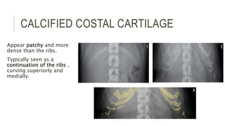 CALCIFIED COSTAL CARTILAGE
Appear patchy and more
dense than the ribs.
Typically seen as a
continuation of the ribs ,
curving superiorly and
medially.
 