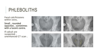PHLEBOLITHS
Focal calcifictaions
within veins.
Small , rounded
opacities , sometimes
with a lucent centre.
If calculi are
suspected ,
unenhanced CT scan .
 