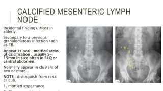 CALCIFIED MESENTERIC LYMPH
NODE
Incidental findings. Most in
elderly.
Secondary to a previous
granulomatous infection such
as TB.
Appear as oval , mottled areas
of calcification , usually 5-
15mm in size often in RLQ or
central abdomen.
Normally appear in clusters of
two or more.
NOTE : distinguish from renal
calculi.
1. mottled appearance
 