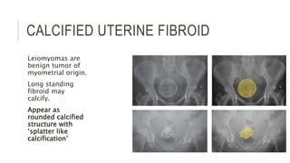 CALCIFIED UTERINE FIBROID
Leiomyomas are
benign tumor of
myometrial origin.
Long standing
fibroid may
calcify.
Appear as
rounded calcified
structure with
‘splatter like
calcification’
 
