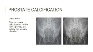 PROSTATE CALCIFICATION
Older men .
Fine or coarse
calcification in the
lower pelvis, just
below the urinary
bladder.
 