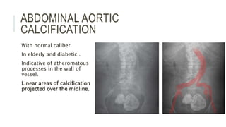 ABDOMINAL AORTIC
CALCIFICATION
With normal caliber.
In elderly and diabetic .
Indicative of atheromatous
processes in the wall of
vessel.
Linear areas of calcification
projected over the midline.
 