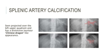 SPLENIC ARTERY CALCIFICATION
Seen projected over the
left upper quadrant and
has a distinctive tourtour
‘Chinese dragon’ like
appearance.
 