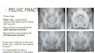 PELVIC FRACTURE
Three rings :
Pelvic ring – paired ilium ,
ischium and pubic bones along
with sacrum
Ring of bone surrounding the
right obturator foramen
Ring of bone surrounding the
left obturator foramen
If you see a fracture in one part
of the ring , look for the second
fracture.
It is impossible to have a
significant fracture in one place
 