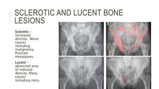 SCLEROTIC AND LUCENT BONE
LESIONS
Sclerotic –
increased
density. Many
causes
including
malignancy.
Prostate
metastases.
Lucent –
abnormal area
of reduced
density. Many
causes
including mets.
 
