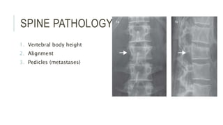 SPINE PATHOLOGY
1. Vertebral body height
2. Alignment
3. Pedicles (metastases)
 