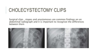 CHOLECYSTECTOMY CLIPS
Surgical clips , stapes and anastomoses are common findings on an
abdominal radiograph and it is important to recognize the differences
between them
 