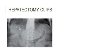 HEPATECTOMY CLIPS
 