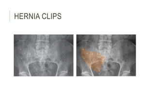 HERNIA CLIPS
 