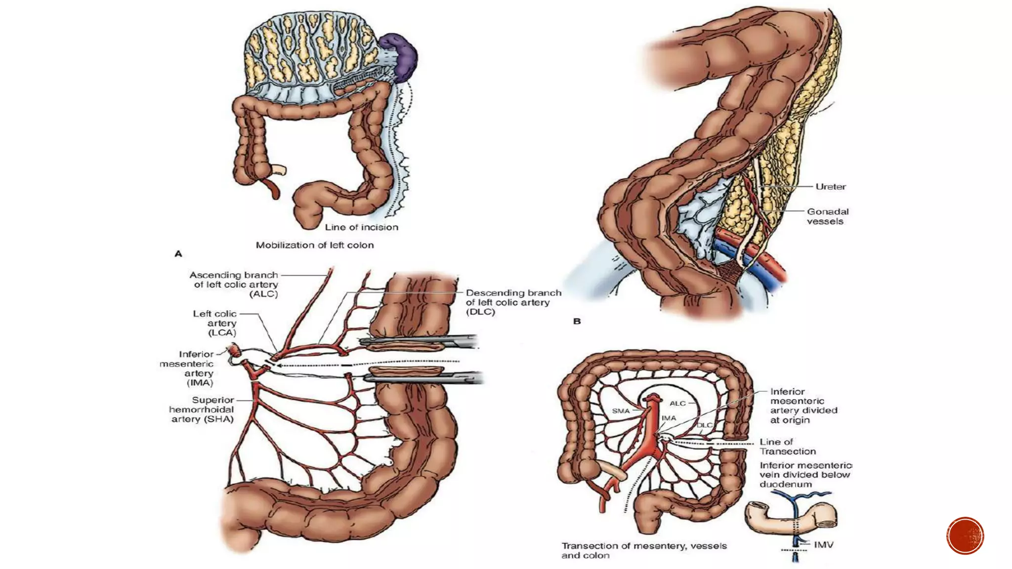 Abdominoperineal resection.pptx