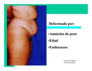 Deformado por:

•Aumento de peso
•Edad
•Embarazos


        Francisco Villegas
        Cirujano Plástico
 