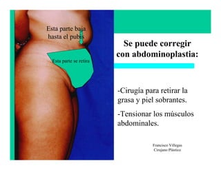 Esta parte baja
hasta el pubis
                           Se puede corregir
                         con abdominoplastia:
  Esta parte se retira




                         -Cirugía para retirar la
                         grasa y piel sobrantes.
                         -Tensionar los músculos
                         abdominales.

                                     Francisco Villegas
                                     Cirujano Plástico
 