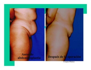 Antes de
abdominoplastia   Después de la operación
                            Francisco Villegas
                            Cirujano Plástico
 