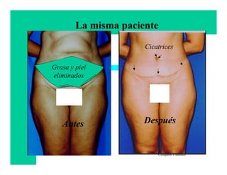 La misma paciente
                      Cicatrices


Grasa y piel
eliminados




   Antes              Después


                          Francisco Villegas
                          Cirujano Plástico
 