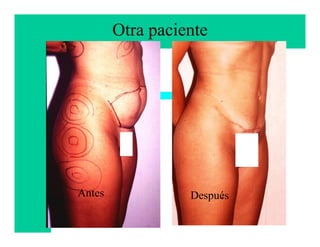 Otra paciente




Antes             Después
                        Francisco Villegas
                        Cirujano Plástico
 