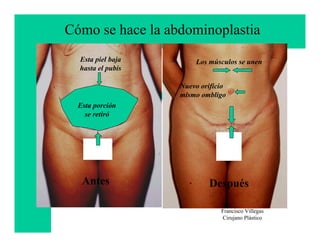 Cómo se hace la abdominoplastia
  Esta piel baja       Los músculos se unen
  hasta el pubis

                   Nuevo orificio
                   mismo ombligo
  Esta porción
    se retiró




   Antes                   Después

                               Francisco Villegas
                               Cirujano Plástico
 