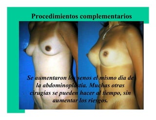 Procedimientos complementarios




Se aumentaron los senos el mismo dia de
    la abdominoplastia. Muchas otras
 cirugías se pueden hacer al tiempo, sin
          aumentar los riesgos.Francisco Villegas
                                     Cirujano Plástico
 