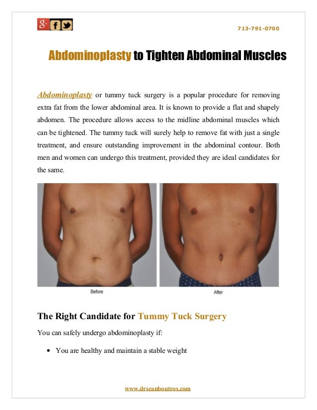 Abdominoplasty to tighten abdominal muscles