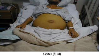 Ascites Sampling abdominal assessment | PPTX