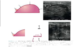 abdo wall of human male and femalehernia.pptx