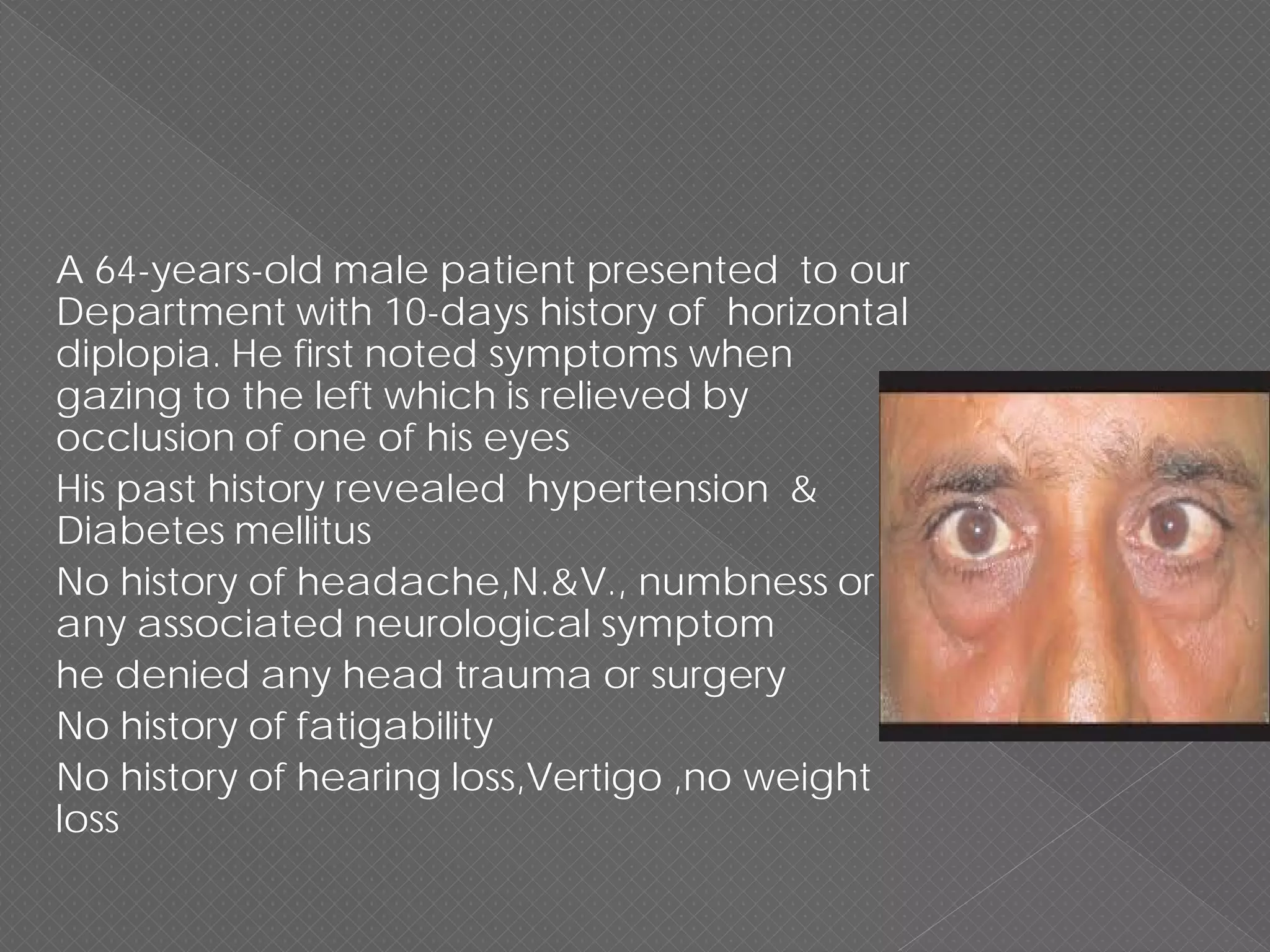 6 th nerve palsy | PDF