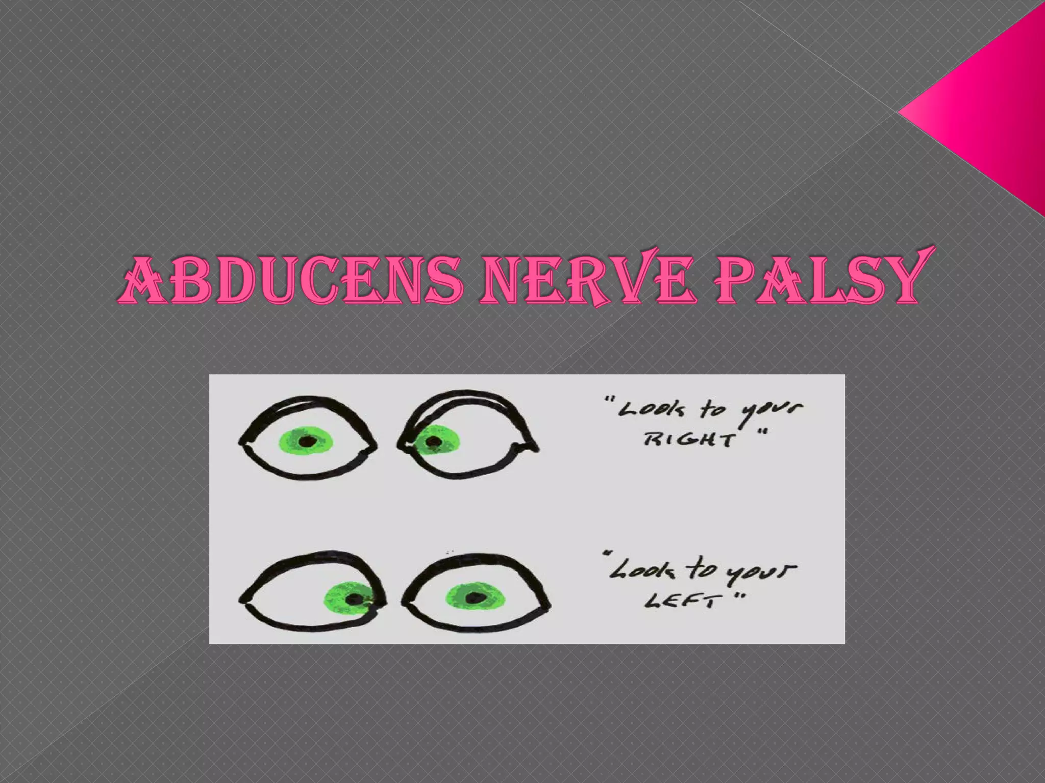 6 th nerve palsy | PDF