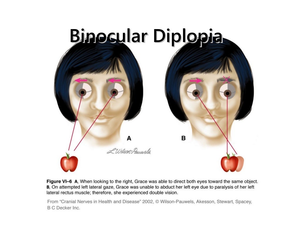 Abducent nerve palsy
