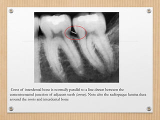 Abdullah .radiographic-aids-in-the-diagnosis-of-periodontal-diseases.pptx