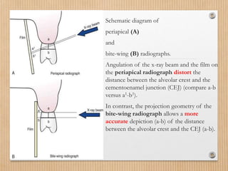 Wing Radiographs Abdullah .radiographic-aids-in-the-diagnosis-of-periodontal-diseases.pptx