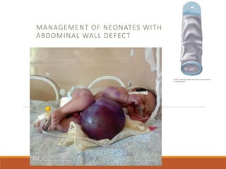 MANAGEMENT OF NEONATES WITH
ABDOMINAL WALL DEFECT
 