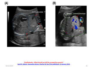 Gastroschisis and omphalocele ; congenital abdominal wall defects | PPTX