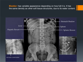 Bladder: has variable appearance depending on how full it is. It has
the same density as other soft tissue structures, due to its water content.
 