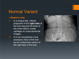 Normal Variant
 Riedel’s Lobe
I. is a tongue-like, inferior
projection of the right lobe of
the liver beyond the level of
the most inferior costal
cartilage on cross-sectional
images.
II. It is not considered a true
accessory lobe of the liver
but an anatomical variant of
the right lobe of the liver.
 