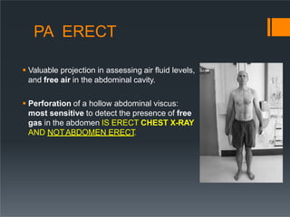 PA ERECT
 Valuable projection in assessing air fluid levels,
and free air in the abdominal cavity.
 Perforation of a hollow abdominal viscus:
most sensitive to detect the presence of free
gas in the abdomen IS ERECT CHEST X-RAY
AND NOTABDOMEN ERECT
.
 