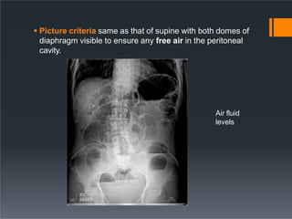  Picture criteria same as that of supine with both domes of
diaphragm visible to ensure any free air in the peritoneal
cavity.
Air fluid
levels
 