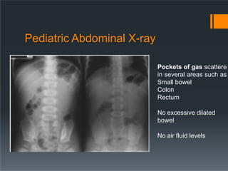 Pediatric Abdominal X-ray
Pockets of gas scattere
in several areas such as
Small bowel
Colon
Rectum
No excessive dilated
bowel
No air fluid levels
 