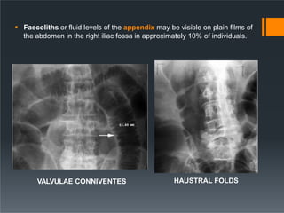 VALVULAE CONNIVENTES HAUSTRAL FOLDS
 Faecoliths or fluid levels of the appendix may be visible on plain films of
the abdo...