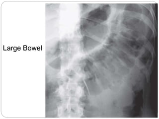 abdominal x ray radiology