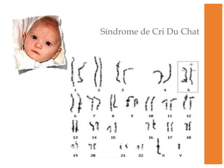 Síndrome de Cri Du Chat 