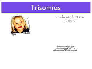 Trisomías Síndrome de Down 47,XX+21 